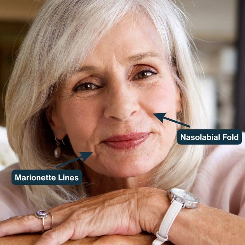 Marionette-lines-nasolabial folds