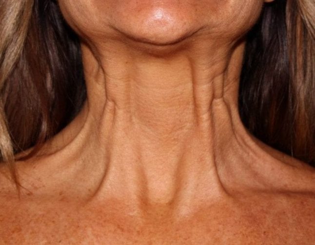 Botox for the neck