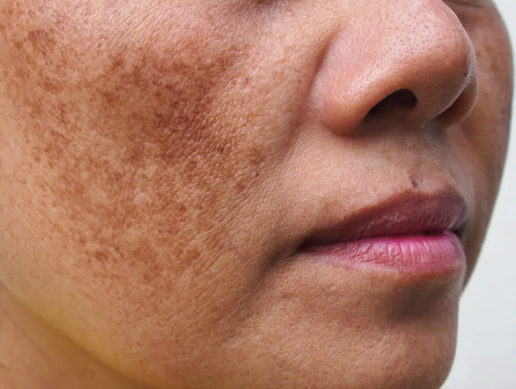 hyperpigmentation treatment