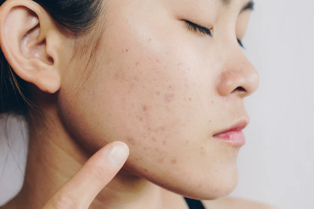 acne scar treatment london