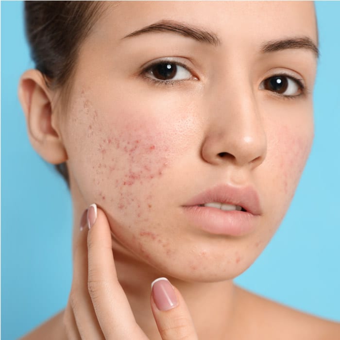 acne scars