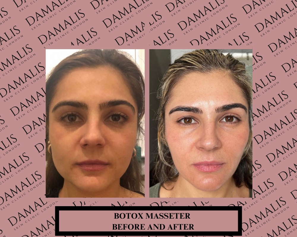 Botox Masseter Before And After Pictures