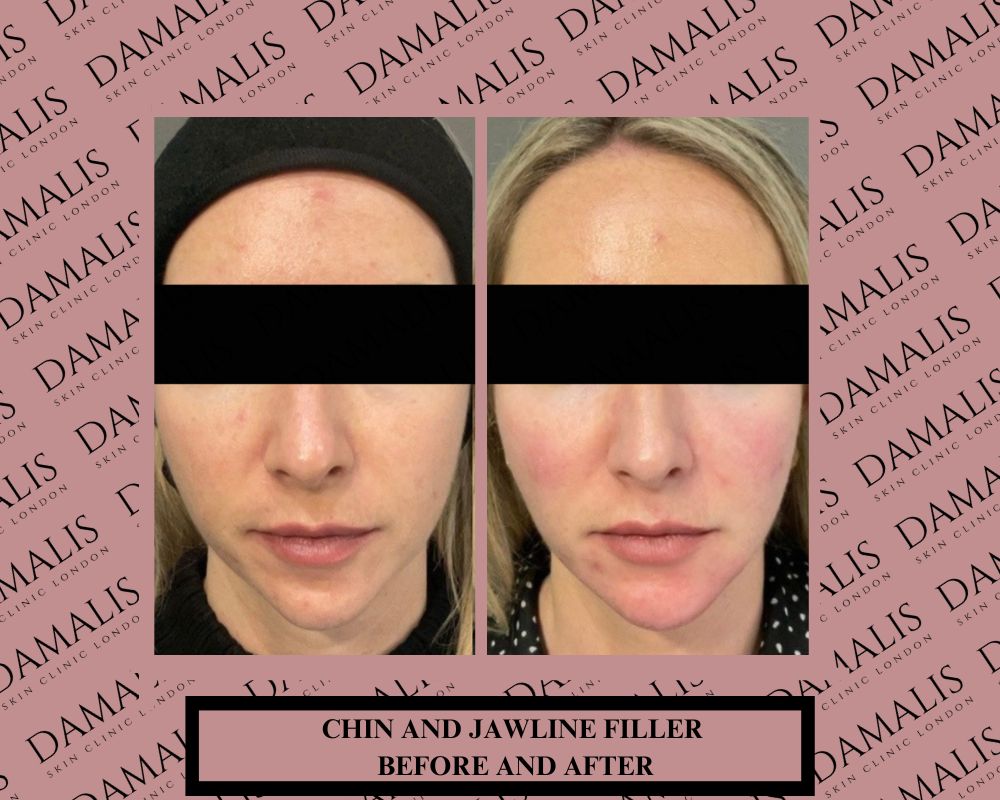 chin and jawline filler before and after (2)