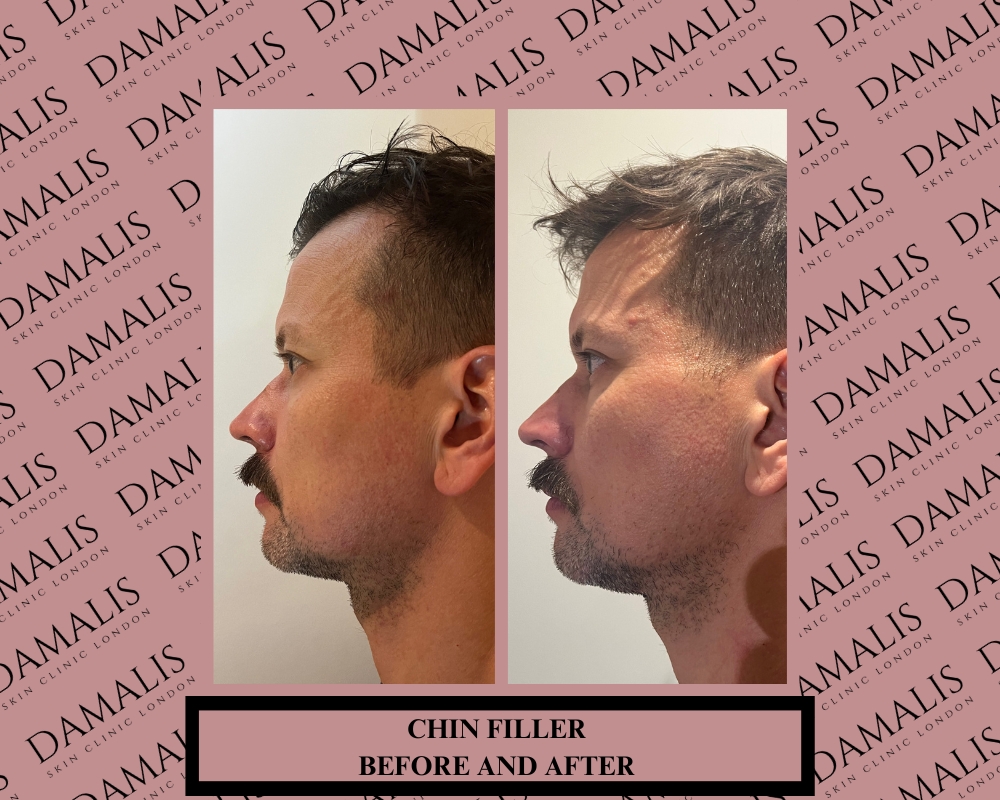 chin filler before and after pictures