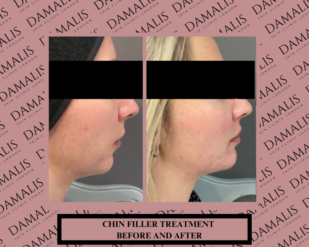 chin filler treatment before and after pictures