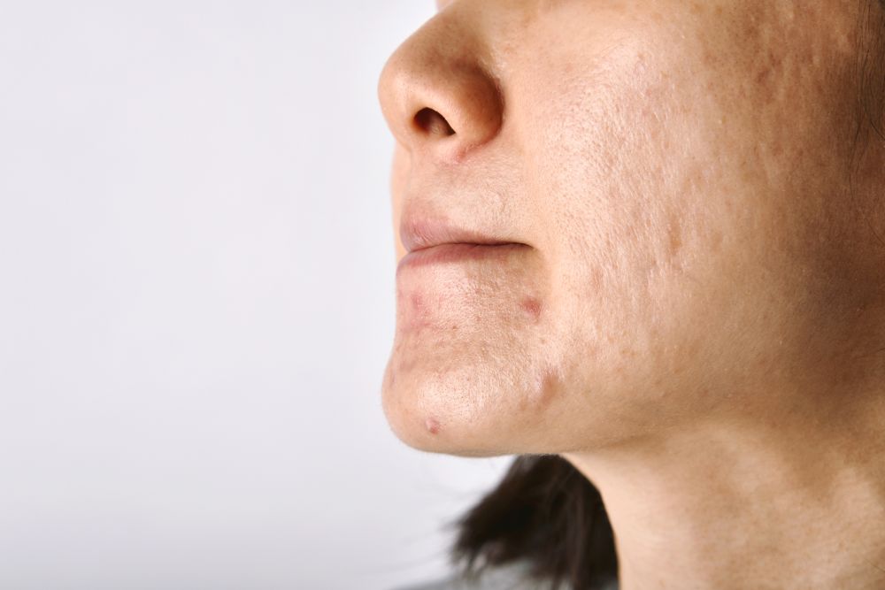 Enlarged pores Skin Clinic London 2