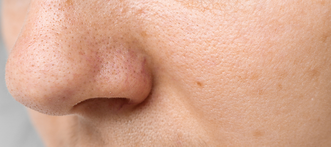 Enlarged pores london banner