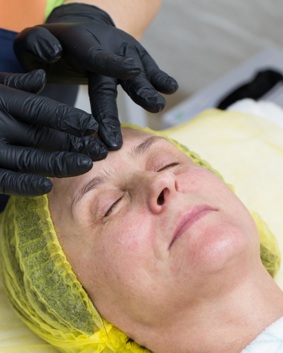 Chemical peels 1