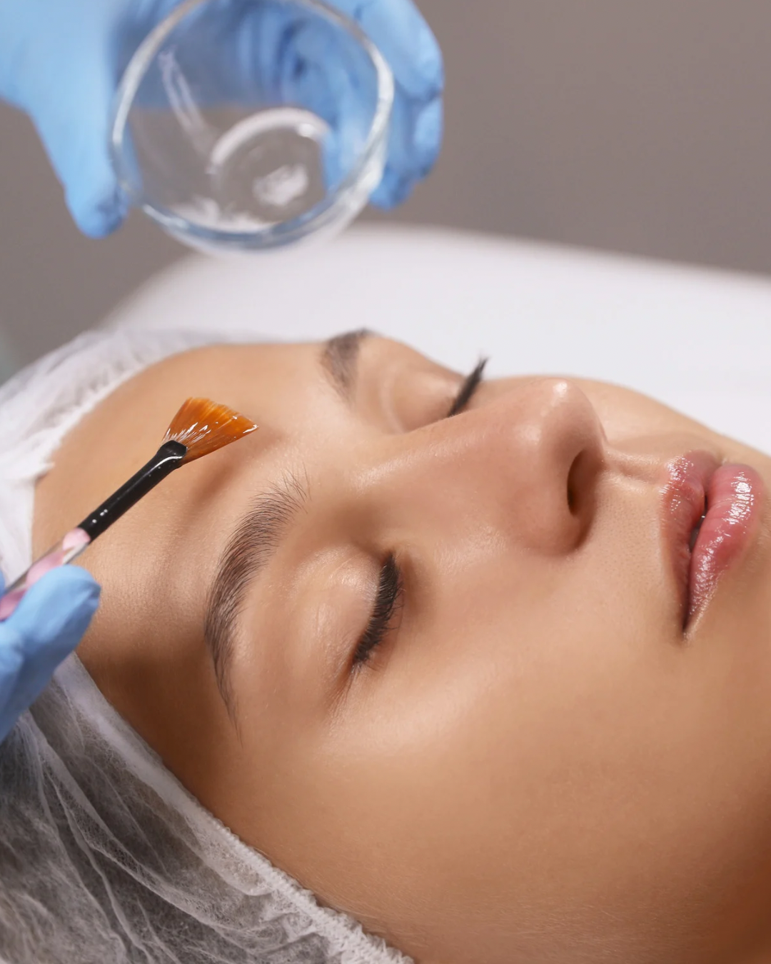 Chemical peels 2