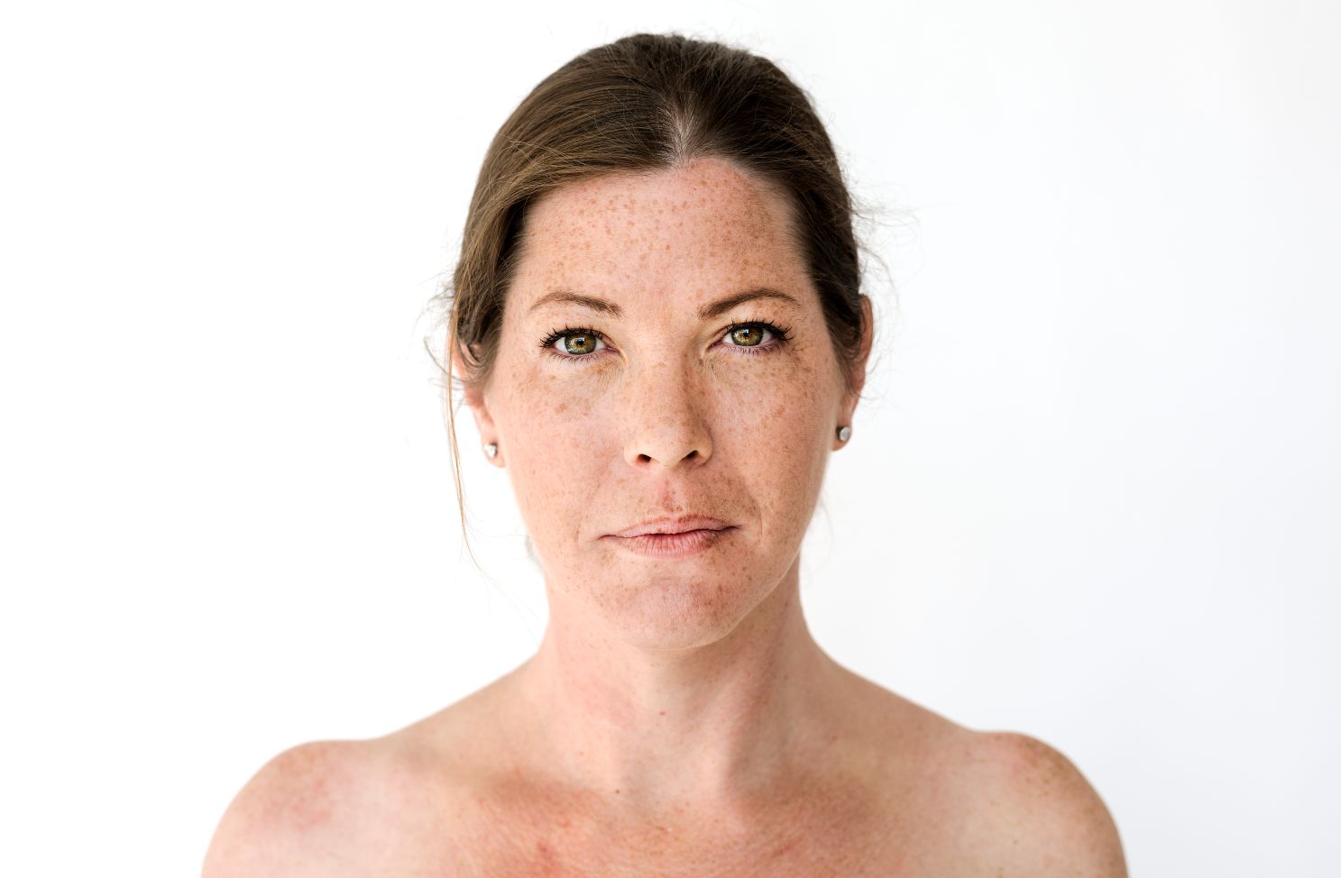 Dull dehydrated skin Skin Clinic London 2