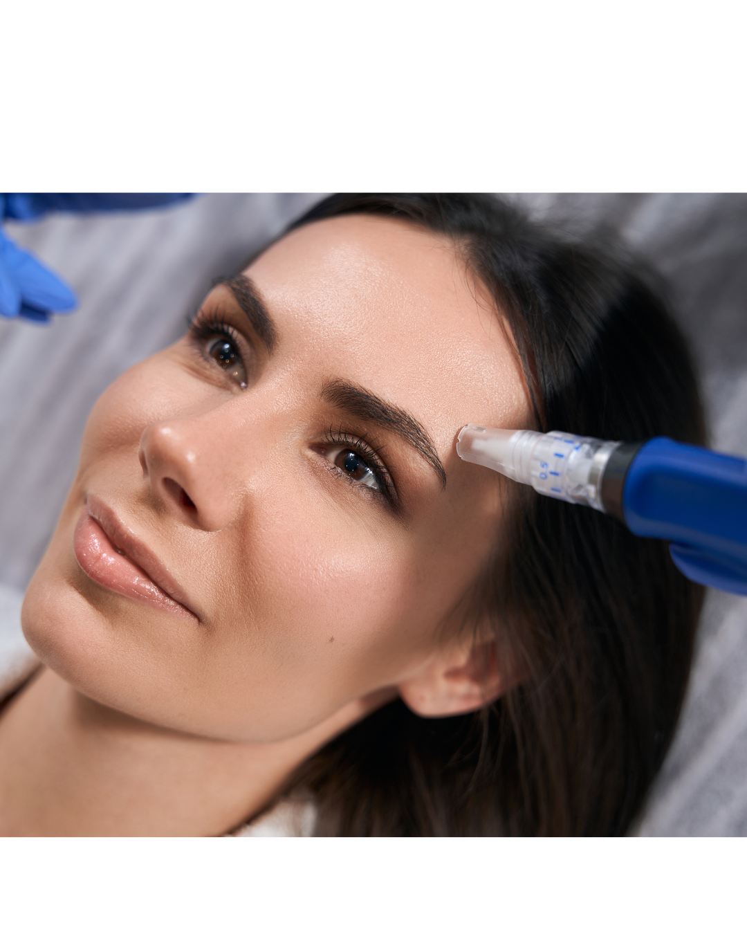 Microneedling with Purasomes 4