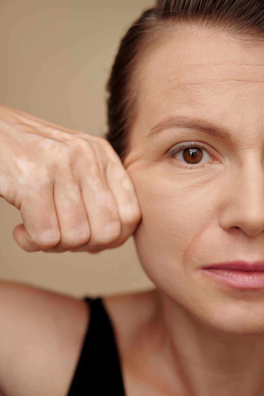 Profhilo Skin Clinic London 3