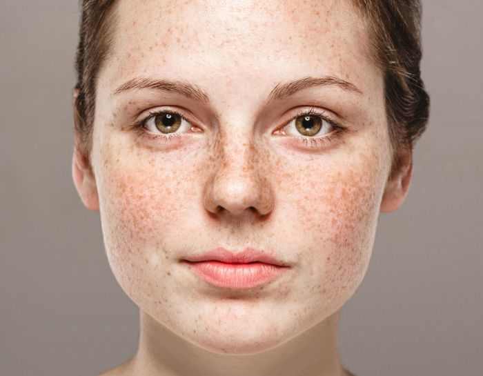 Rosacea Skin Clinic London