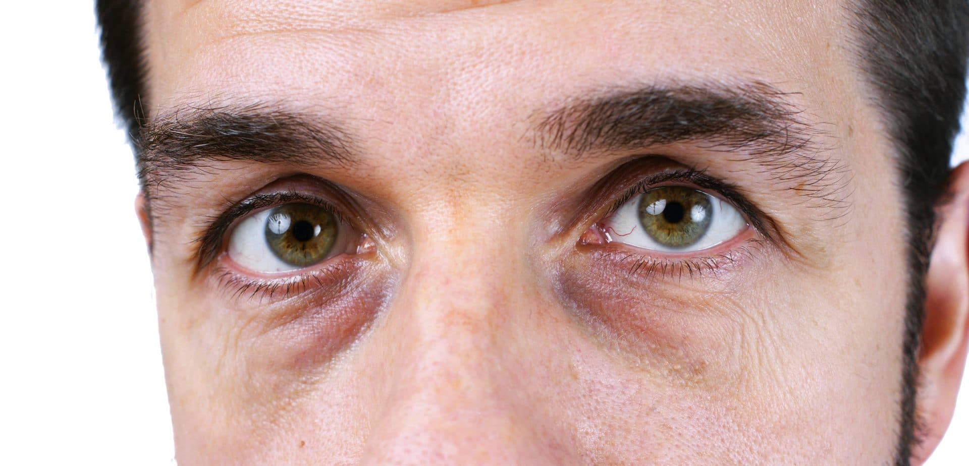 dark circles man