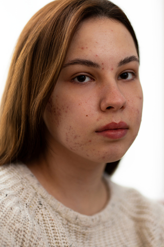 skin pigmentation condition woman 1